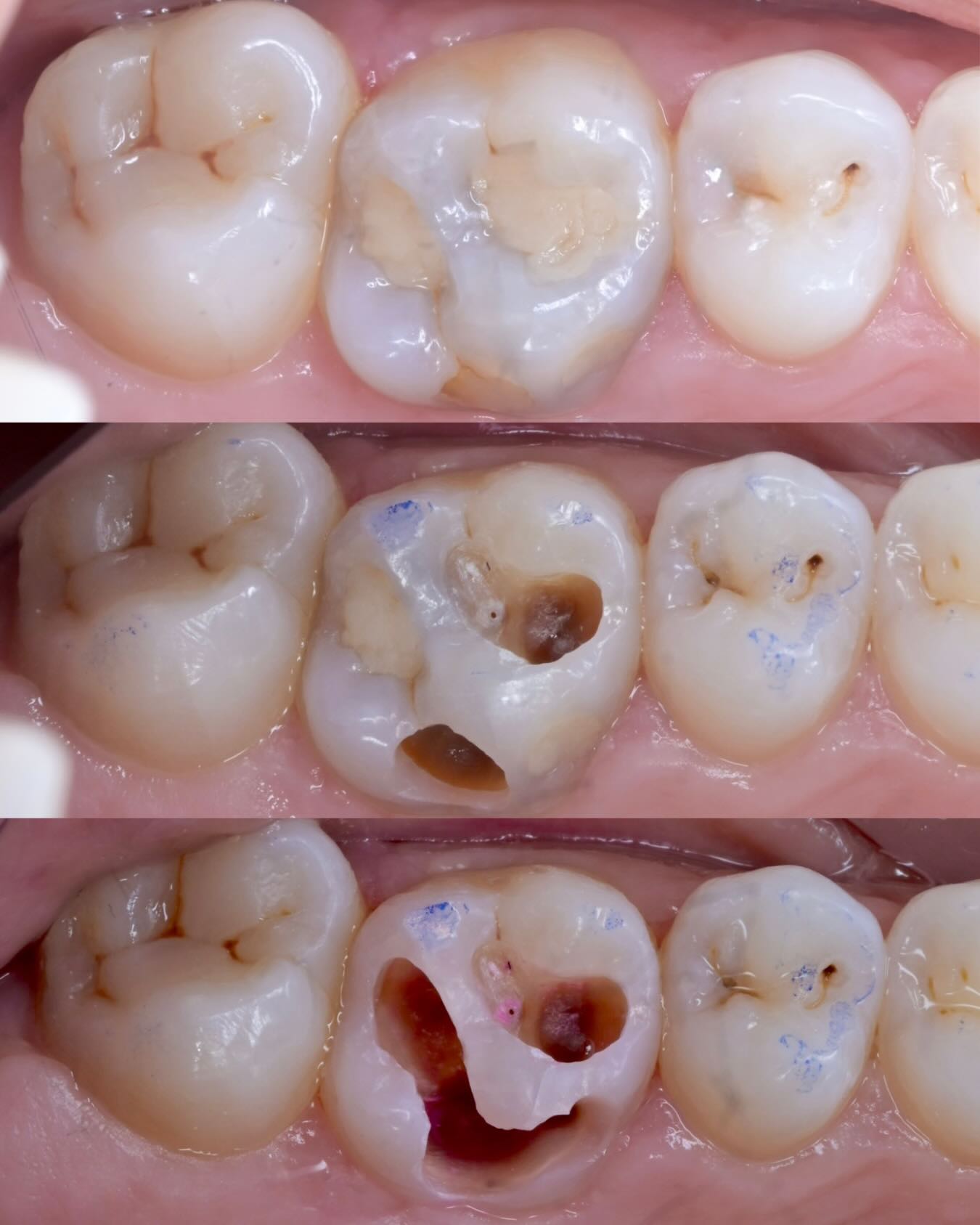 new decay under the edge of a composite filling