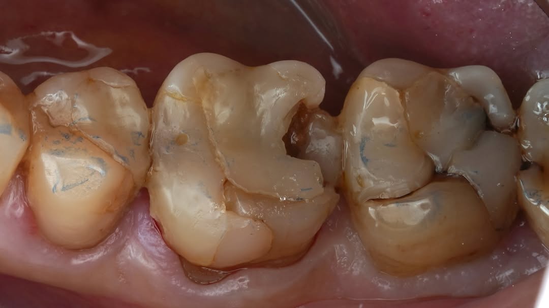 a shrinkage gap and crack beside a composite filling