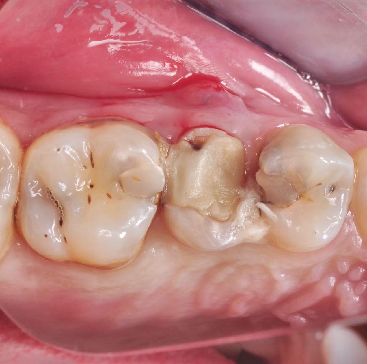 a worn composite that has opened a food trap between molars